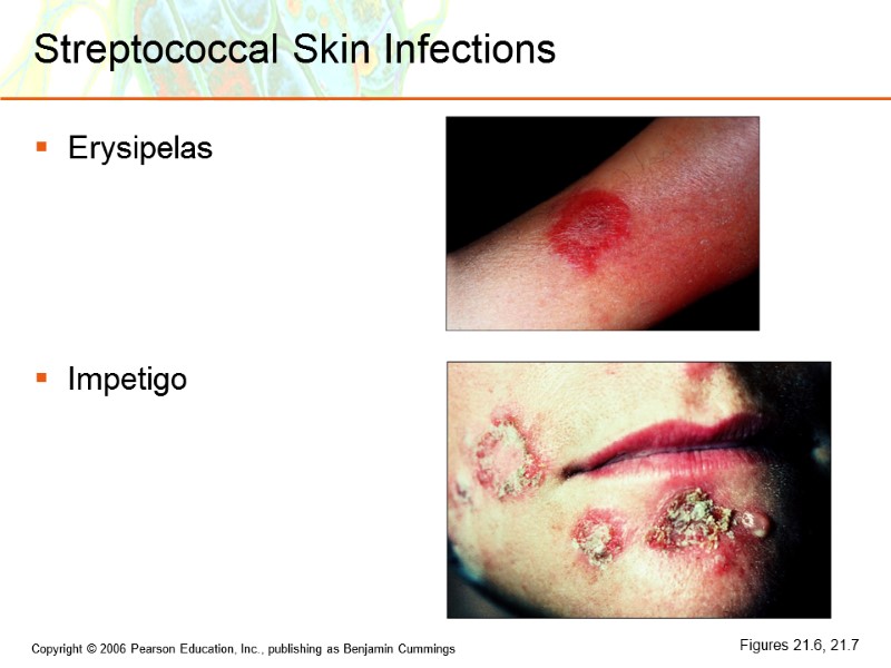 Streptococcal Skin Infections Erysipelas    Impetigo Figures 21.6, 21.7